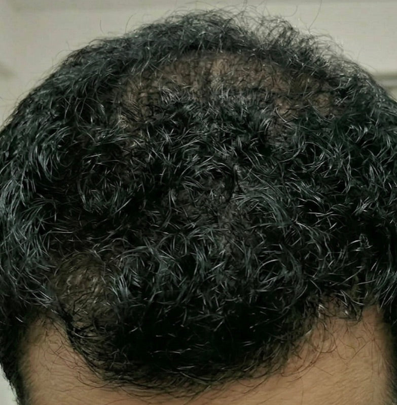 After treatment